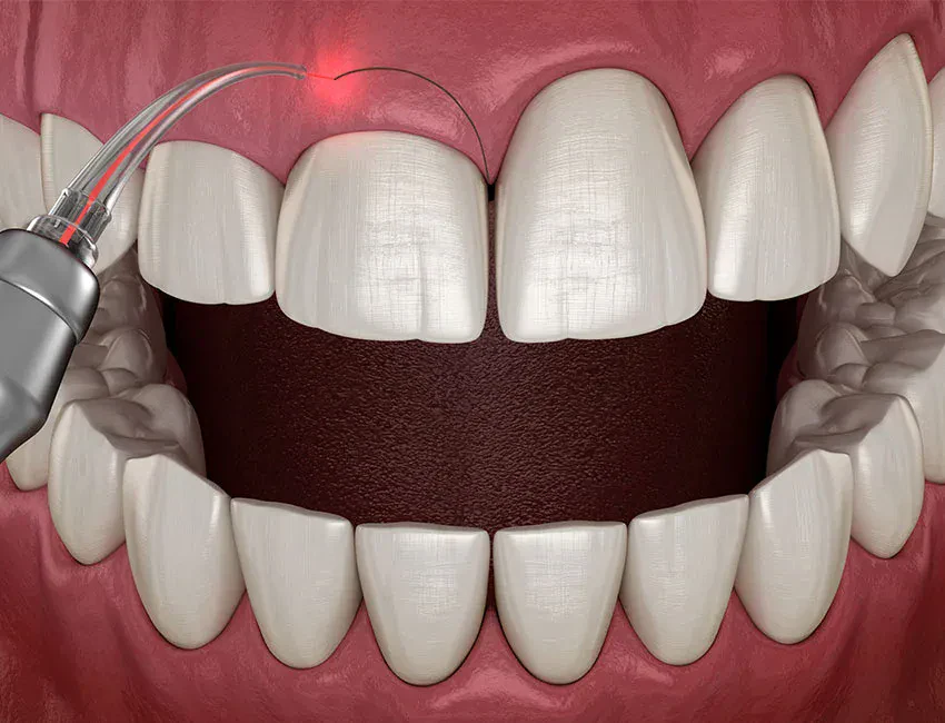 gummy smile treatment