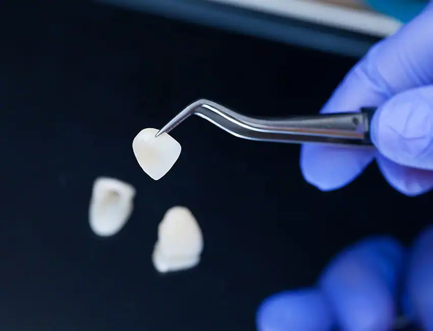 porcelain veneers