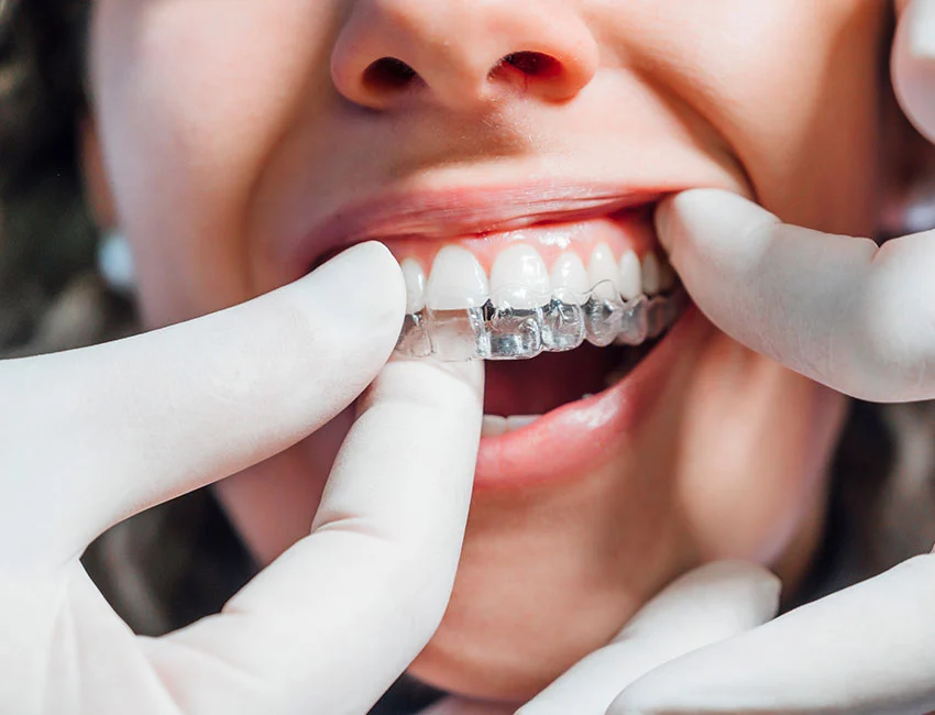 crooked teeth