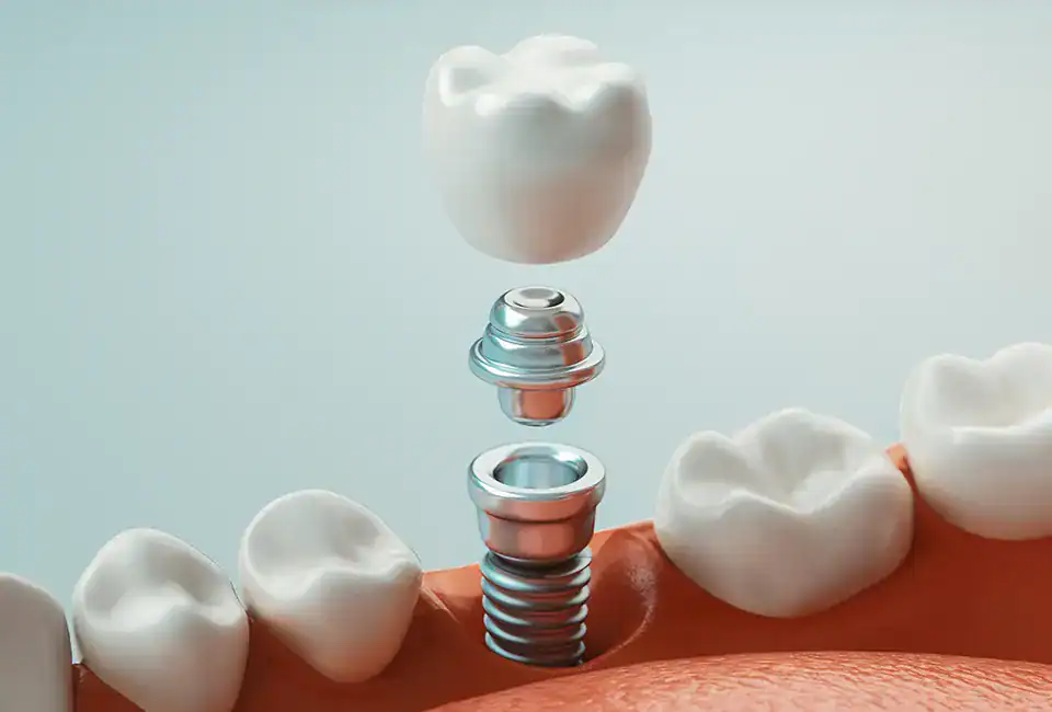 missing tooth