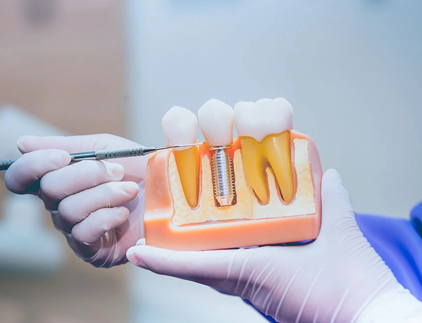 dental implants