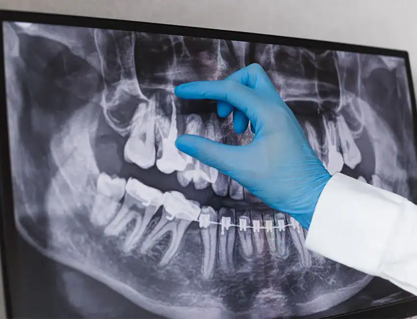 endodontic therapy