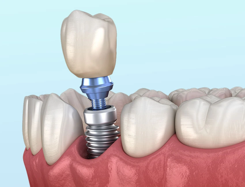 types of dental implants