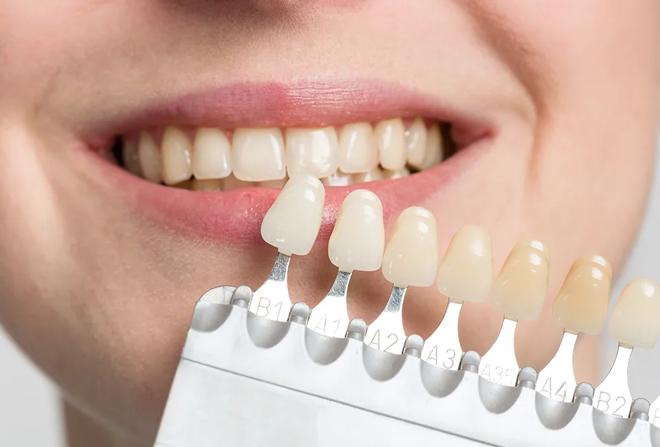 tooth-color-matching teeth whitening treatments